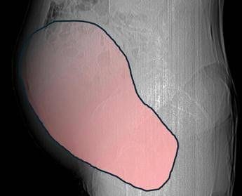 Intervento record al Sant'Anna di Torino, rimosso tumore ovarico di 6 kg